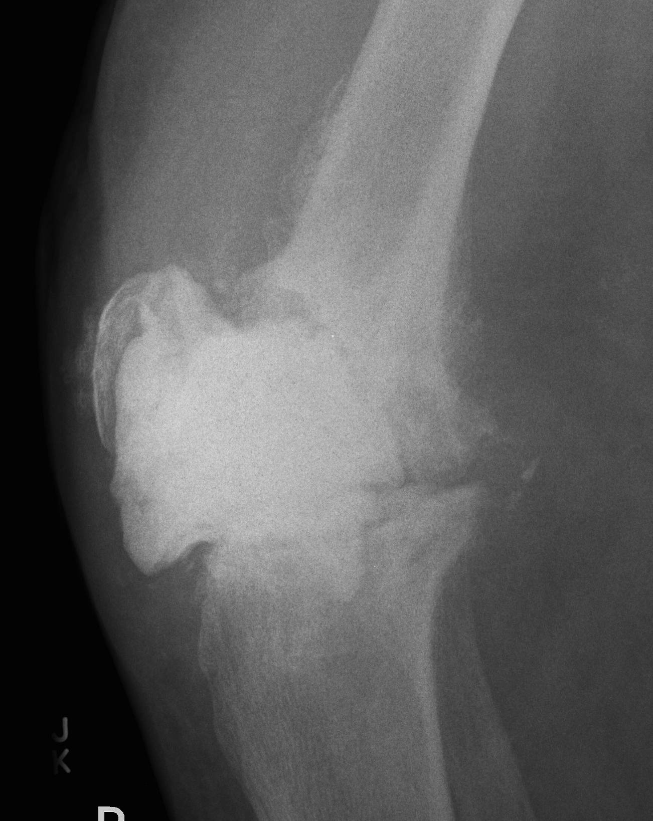 Infected TKR Cement Ball Lateral